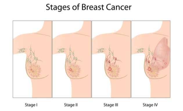 Stages of Breast Cancer - Knowledge Showledge – Divine Hindu Religion Spiritual Blog on Hinduism or Hindu Dharma