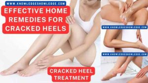 Home Remedies for Cracked Heels